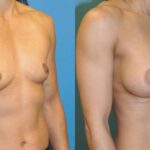 Breast Implant #53 - Before and After