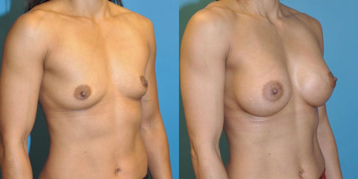 Breast Implant #53 - Before and After