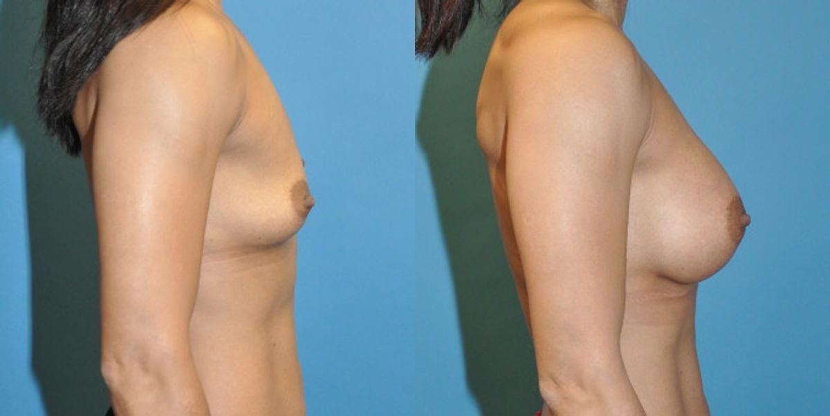 Breast Implant #53 - Before and After