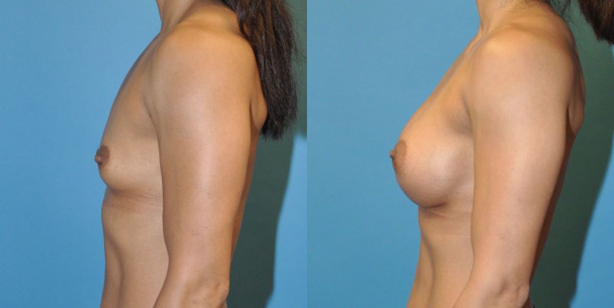 Breast Implant #53 - Before and After