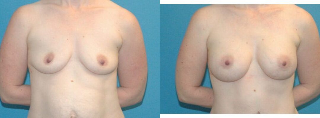 Breast Implant #54
