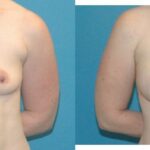 Breast Implant #54 - Before and After