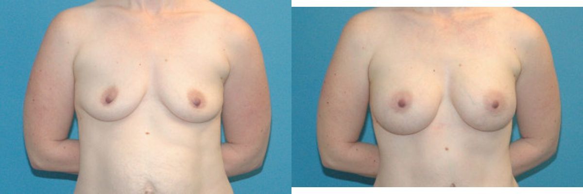 Breast Implant #54 - Before and After