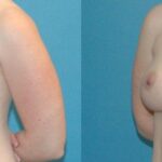 Breast Implant #54 - Before and After