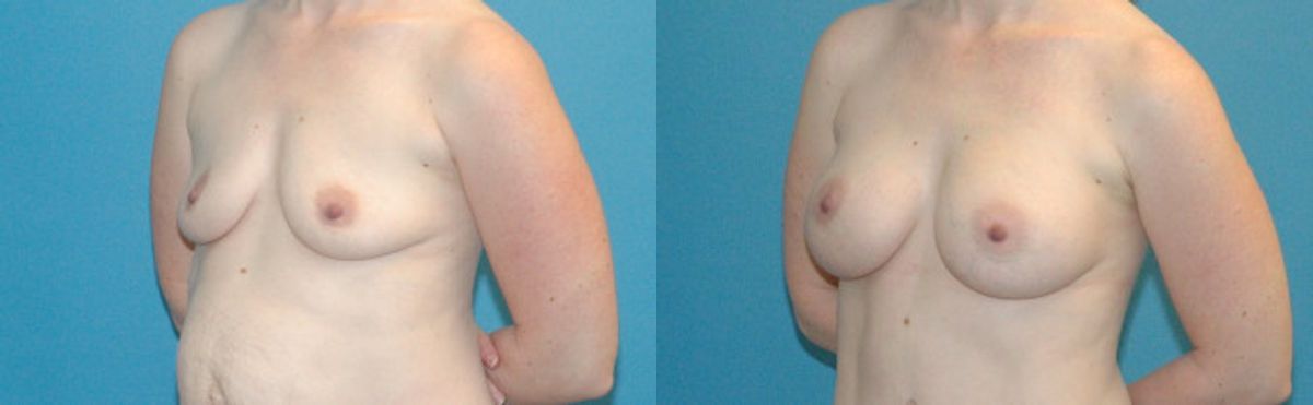 Breast Implant #54 - Before and After