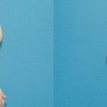 Breast Implant #54 - Before and After