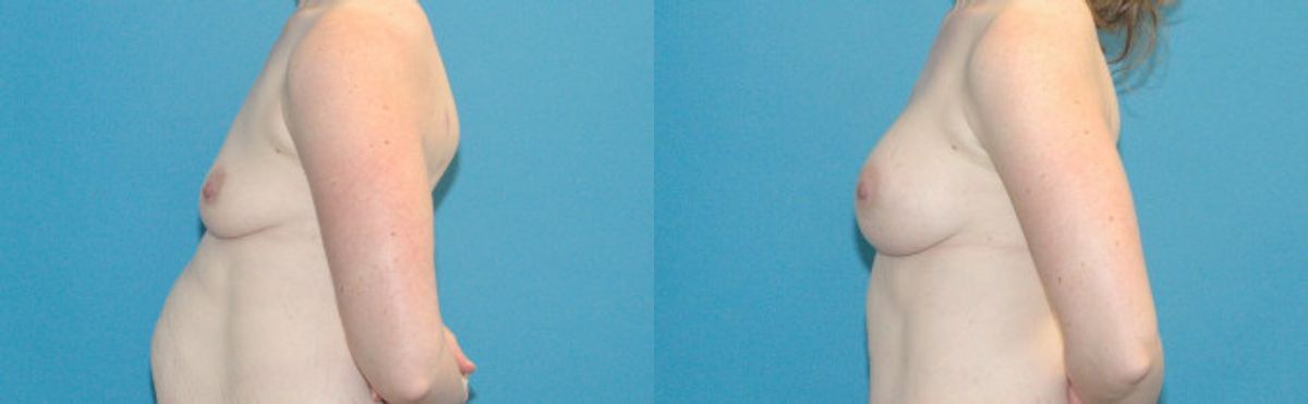 Breast Implant #54 - Before and After