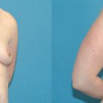 Breast Implant #54 - Before and After