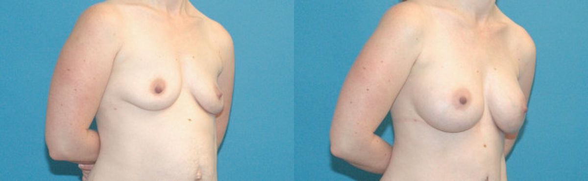 Breast Implant #54 - Before and After