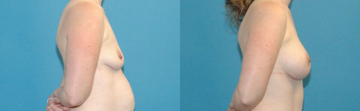 Breast Implant #54 - Before and After