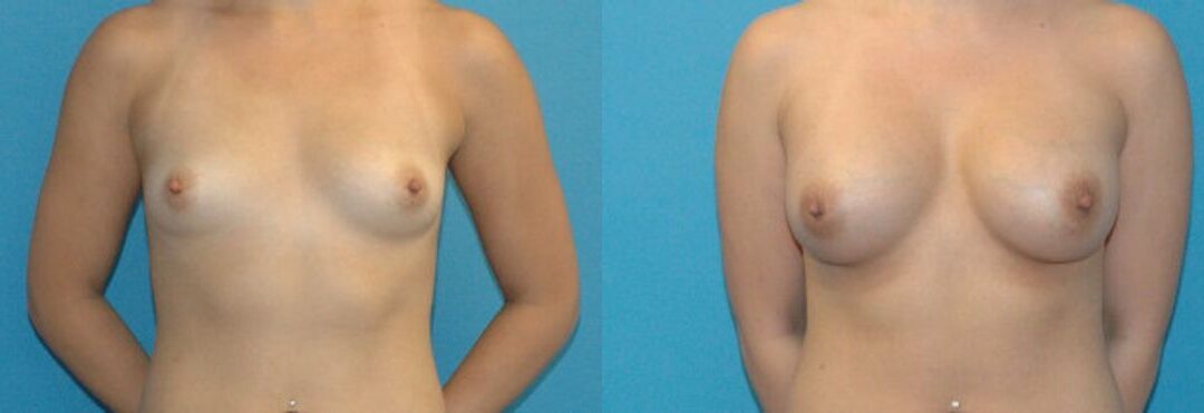 Breast Implant #55