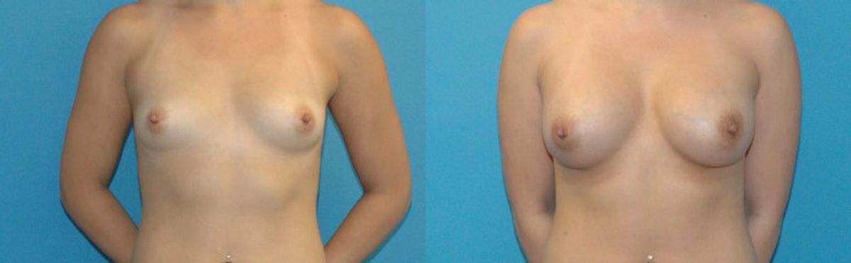 Breast Implant #55 - Before and After