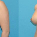 Breast Implant #55 - Before and After
