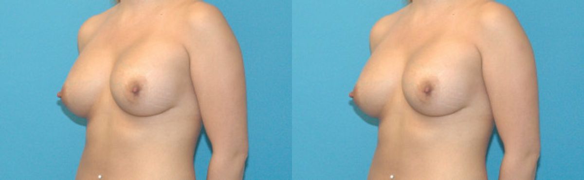 Breast Implant #55 - Before and After