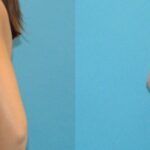 Breast Implant #55 - Before and After