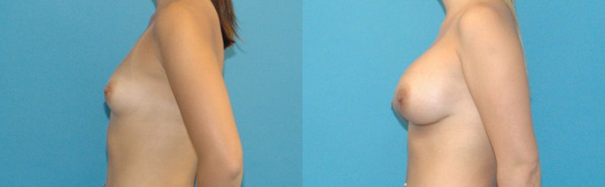 Breast Implant #55 - Before and After