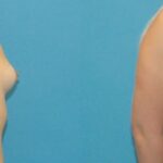 Breast Implant #55 - Before and After