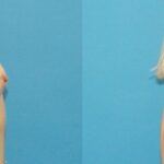 Breast Implant #55 - Before and After