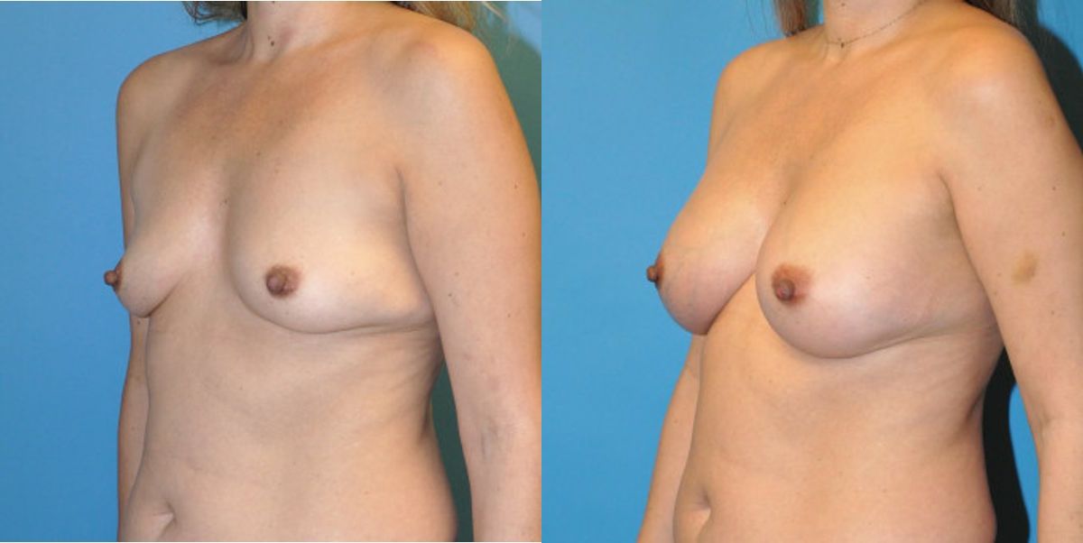 Breast Implant #56 - Before and After