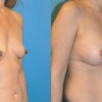 Breast Implant #56 - Before and After