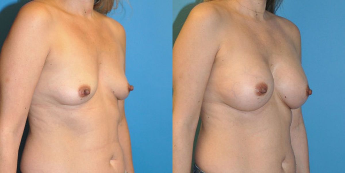 Breast Implant #56 - Before and After