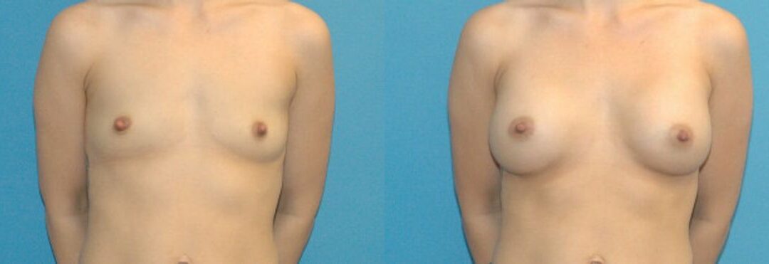 Breast Implant #57