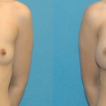 Breast Implant #57 - Before and After