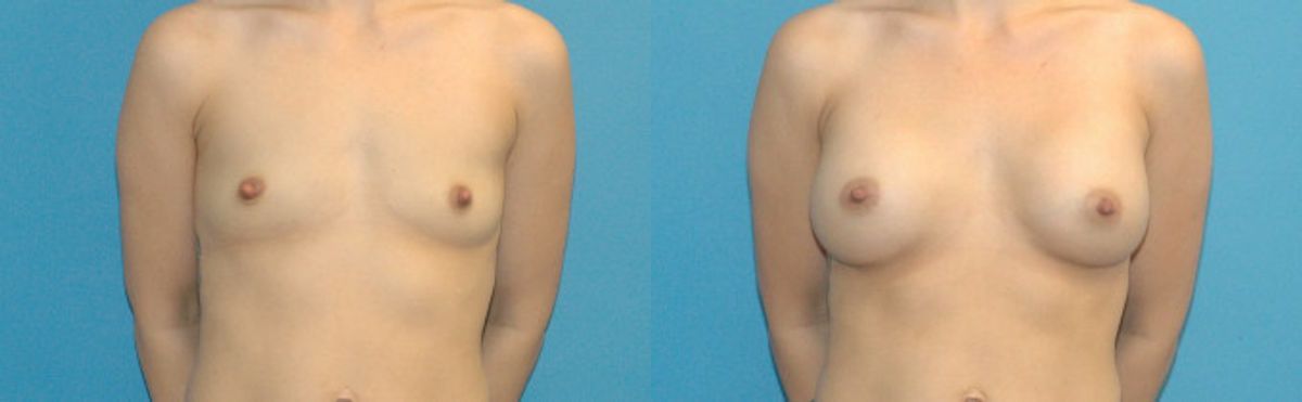 Breast Implant #57 - Before and After