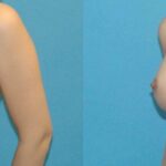 Breast Implant #57 - Before and After