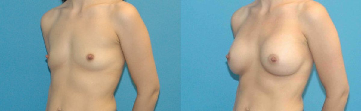 Breast Implant #57 - Before and After