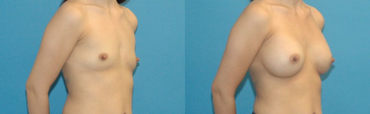 Breast Implant #57 - Before and After