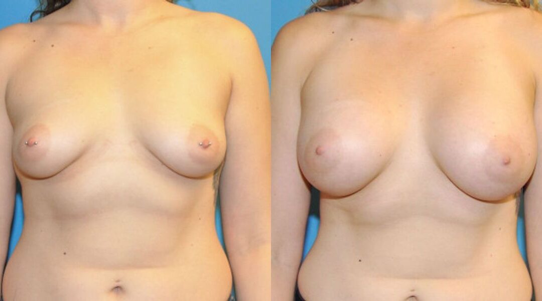Breast Implant #58