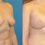 Breast Implant #58 - Before and After