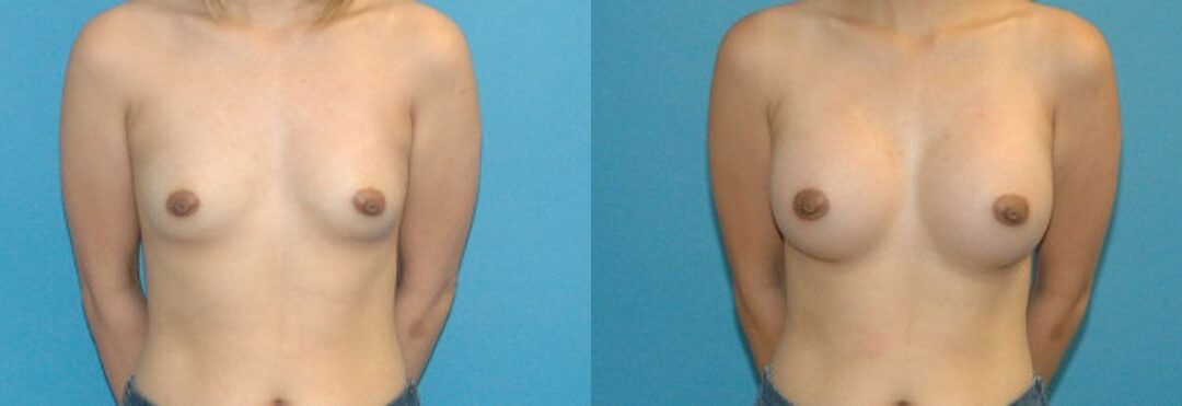 Breast Implant #59