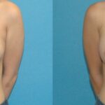 Breast Implant #59 - Before and After