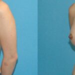 Breast Implant #59 - Before and After