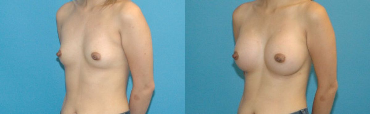 Breast Implant #59 - Before and After