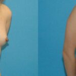 Breast Implant #59 - Before and After