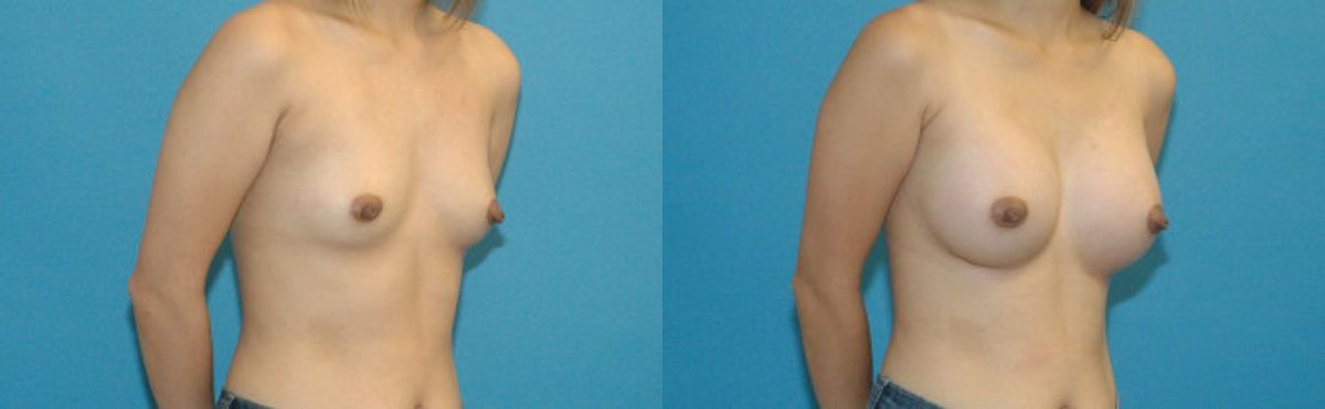 Breast Implant #59 - Before and After