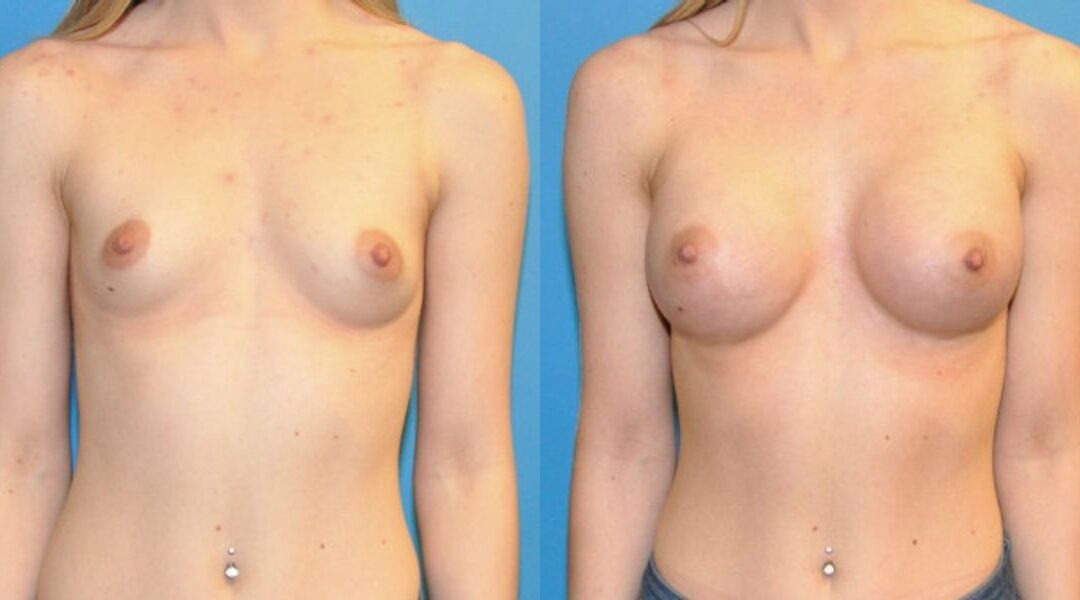 Breast Implant #60