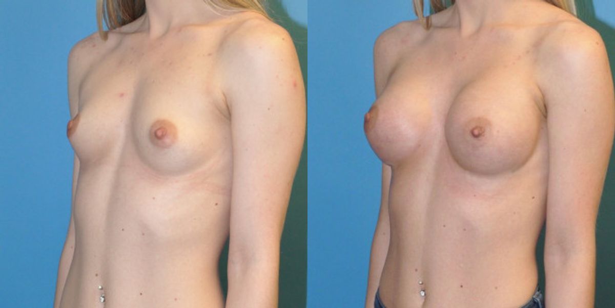 Breast Implant #60 - Before and After