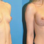 Breast Implant #60 - Before and After