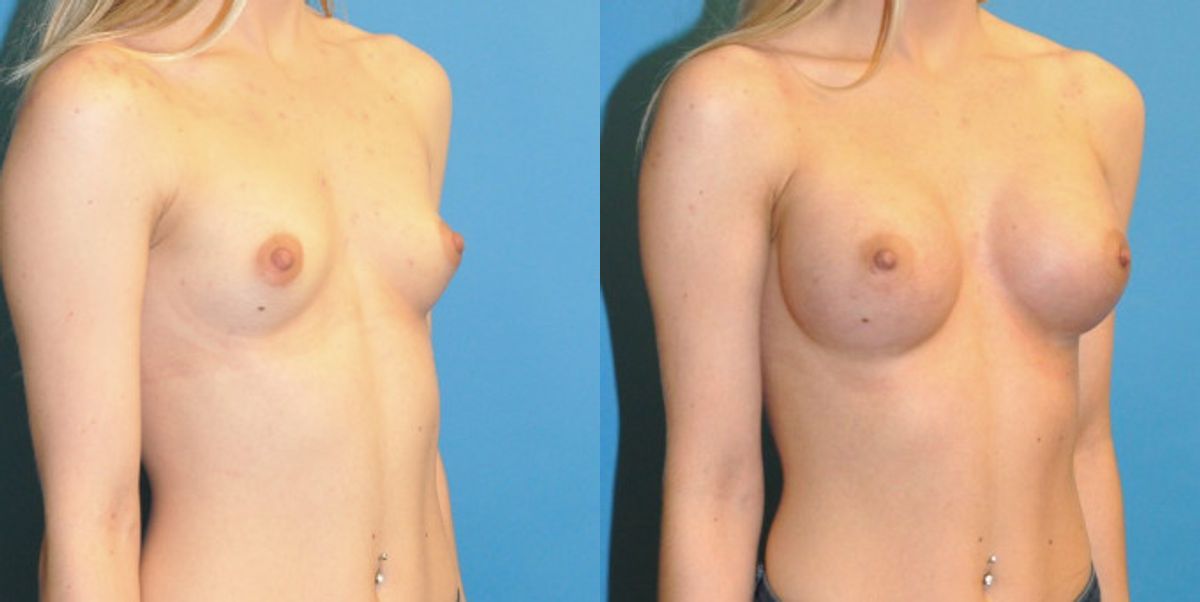 Breast Implant #60 - Before and After