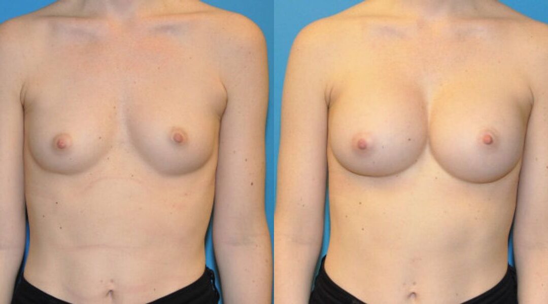 Breast Implant #61