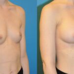 Breast Implant #61 - Before and After