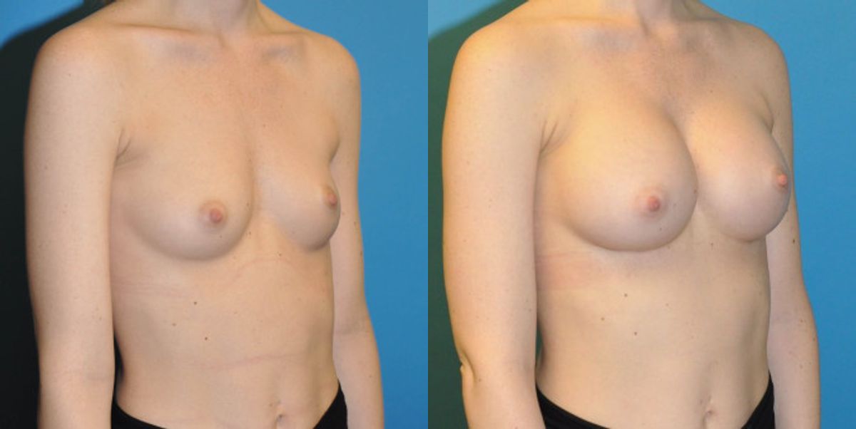 Breast Implant #61 - Before and After