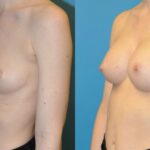 Breast Implant #61 - Before and After