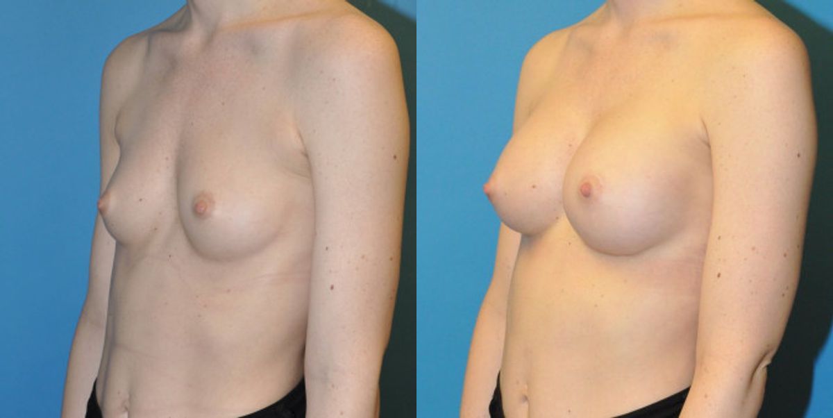 Breast Implant #61 - Before and After