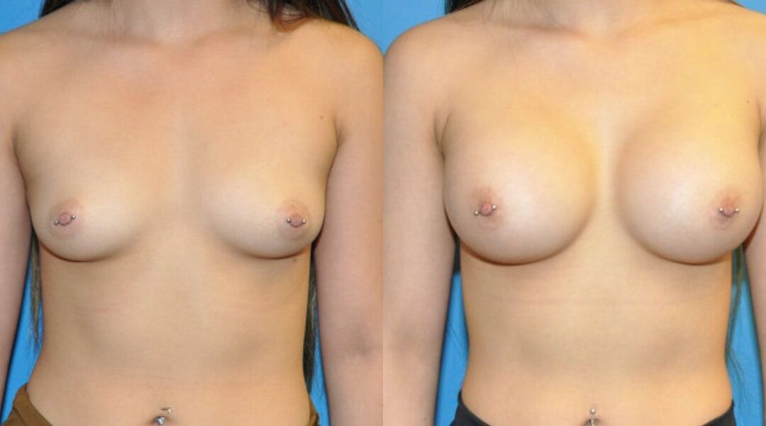 Breast Implant #62