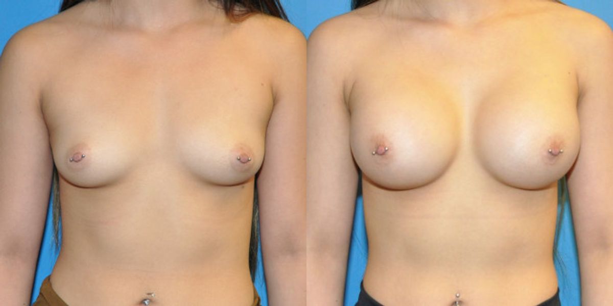 Breast Implant #62 - Before and After